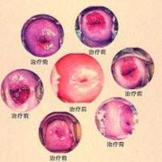 孕期宫颈疼（宫颈口痛是怎么回事）