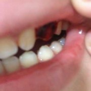 孕期牙龈出血怎么回事（孕期牙龈出血怎么回事儿）