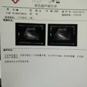 胎儿胎心170（NT胎心170正常吗）