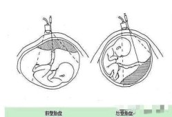 胎儿子宫（胎儿子宫前壁和后壁哪个好）