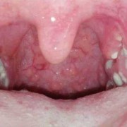 孕期喉咙烧灼（孕期喉咙烧灼感是什么原因引起的）
