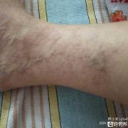 孕期静脉曲张图片（孕期静脉曲张图片大全）