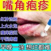 有孕期长了口唇疱疹的吗,孕期嘴唇疱疹可以擦什么药
