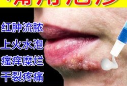 有孕期长了口唇疱疹的吗,孕期嘴唇疱疹可以擦什么药
