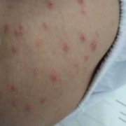 孕晚期大腿内侧长湿疹的很痒怎么治疗,孕期腿上长癣怎么办
