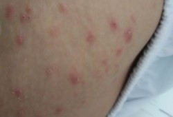 孕晚期大腿内侧长湿疹的很痒怎么治疗,孕期腿上长癣怎么办