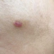 孕期痔疮会自己恢复吗（痔疮术后创面留下疤痕疙瘩会自己吸收吗）