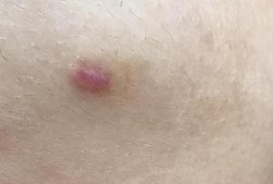 孕期痔疮会自己恢复吗（痔疮术后创面留下疤痕疙瘩会自己吸收吗）