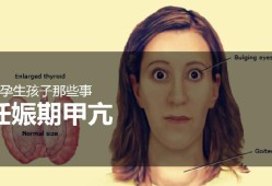 请问大家甲亢对胎儿智力的影响大吗,孕期甲亢胎儿聪明的表现