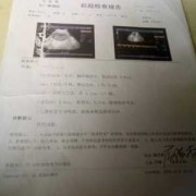 胎儿几个月查畸形（怀孕四个月做唐氏筛查，可以查出胎儿的智商与畸形是不是正常吗）