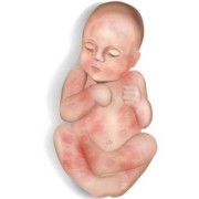 梅毒的胎儿（梅毒会传染给孩子吗）
