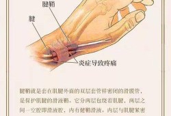 孕期腱鞘炎怎么办,孕期腱鞘炎怎么治疗最好最有效