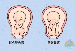 胎儿是臀位可以顺产吗（胎儿是臀位可以顺产吗图片）