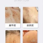 我于怀孕期间在脸，胸部长了一些丝状疣和扁平疣，怎么办,孕期长疣的原因,可以治好吗