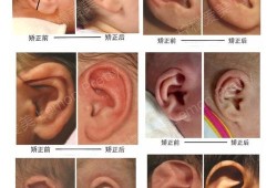 孕期胎儿畸形（宝宝耳朵怎么会畸形的啊？怀孕期间需要注意哪些呢）