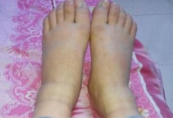 孕期腿两侧（孕期腿两侧疼）