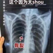 胎儿少一根肋骨能要吗（胎儿少一根肋骨长大后会有影响吗）