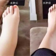 孕期腿水肿（怀孕期间的孕妇腿肿是怎么回事）
