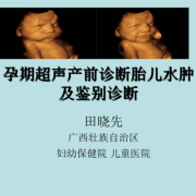 怀孕胎儿水肿有救吗，胎儿水肿如何治疗,孕期水肿好吗会胎停吗