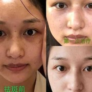 小女孩脸上长斑应该怎么办,孕期脸上长斑生男生女怎么办