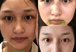 小女孩脸上长斑应该怎么办,孕期脸上长斑生男生女怎么办