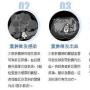 肝囊肿是怎么形成的,胎儿囊肿是什么原因引起的