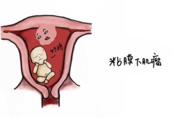 孕期出现子宫肌瘤（孕期出现子宫肌瘤怎么办）