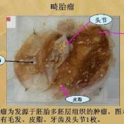 畸胎瘤到底是什么,胎儿畸胎瘤是怎么形成的原因