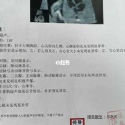 胎儿双心室点状强回声（胎儿双心室点状强回声要紧吗）