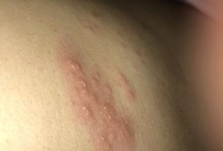 孕妇肚子上长湿疹怎么办,孕期肚皮湿疹怎么办啊