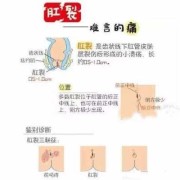 肛裂能怀孕吗,孕期肛裂怎么办每次拉屎都出血