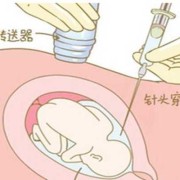 做羊水穿刺对胎儿有影响吗（孕妇抽羊水检查对胎儿有危害吗）