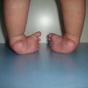 胎儿内翻足（胎儿内翻足在肚子里会好吗）