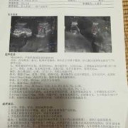 胎儿下腹部肠管回声增强（胎儿下腹部肠管回声增强怎么办）