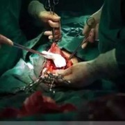 剖腹产的胎儿（剖腹产阴道口会扩张吗）
