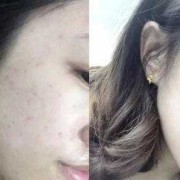 孕期身上长痘（孕妇长痘适合用什么面霜）