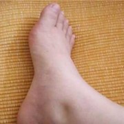 孕妇水肿是怎么回事,孕期水肿表现有哪些
