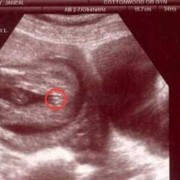 b超对胎儿有影响吗（怀孕做B超医生用力摁敲打肚子对孩子有影响吗）