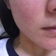 孕期脸上过敏怎么办,孕期脸部过敏怎么办