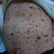 孕期得了疥疮（孕期得了疥疮）