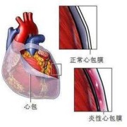 胎儿心包腔积液（胎儿心包腔积液是怎么导致的）