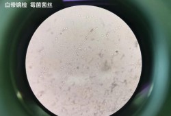 孕期霉菌复发（孕期霉菌复发怎么办）