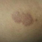 大腿内侧长有黑斑是怎么回事？还有私处发黑是怎么回事,孕期大腿内侧变黑什么原因