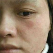 孕期脸干怎么办,孕期脸疼怎么回事