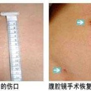 孕期囊肿手术（孕期囊肿手术是微创还是开腹）