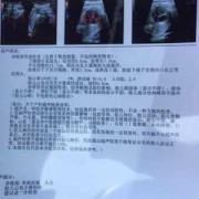 胎儿心包积液（胎儿心包积液正常范围）