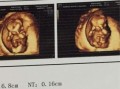三个月胎儿彩超（三个月胎儿彩超）