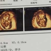 三个月胎儿彩超（三个月胎儿彩超）