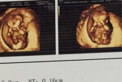 三个月胎儿彩超（三个月胎儿彩超）