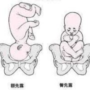 胎儿头朝向（胎儿头朝向在肚子的位置变化）